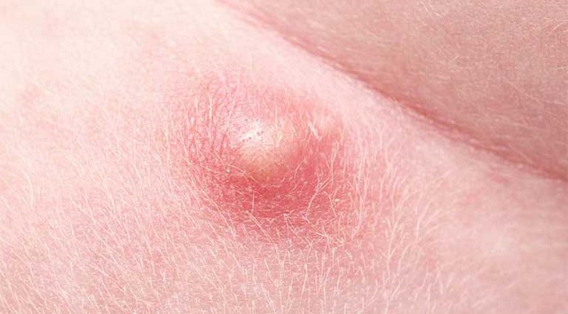 Phân biết áp xe hậu môn và mụn nhọt bình thường