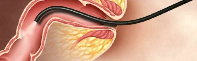 Quy trình nội soi hậu môn trực tràng có phức tạp không?