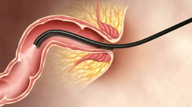 Quy trình nội soi hậu môn trực tràng có phức tạp không?