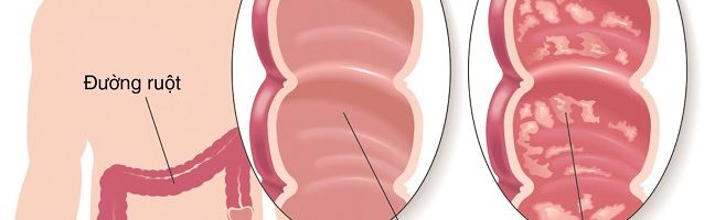 Viêm đại tràng có nguy cơ mắc bệnh trĩ không?