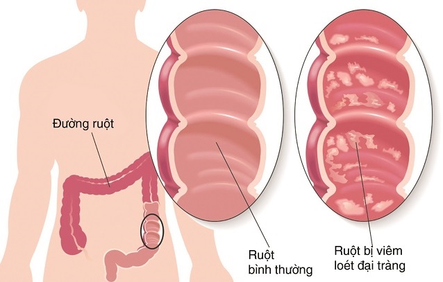 Viêm đại tràng có nguy cơ mắc bệnh trĩ không?