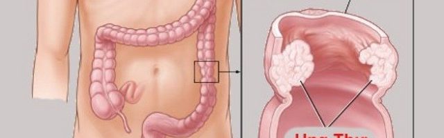 Bệnh trĩ có gây ung thư không và ảnh hưởng gì như thế nào đến sức khỏe?