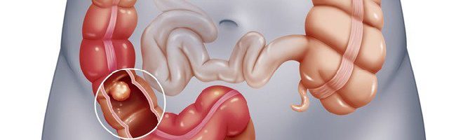 Bệnh trĩ và ung thư đại tràng có biểu hiện giống nhau hay không