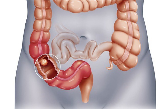 Bệnh trĩ và ung thư đại tràng có biểu hiện giống nhau hay không