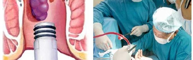 Chăm sóc người bệnh sau thắt búi trĩ