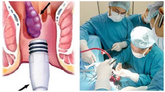 Chăm sóc người bệnh sau thắt búi trĩ