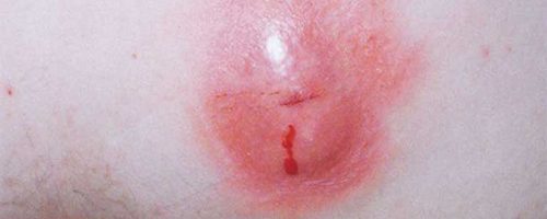 Phân biệt rò hậu môn với apxe hậu môn