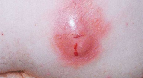 Phân biệt rò hậu môn với apxe hậu môn