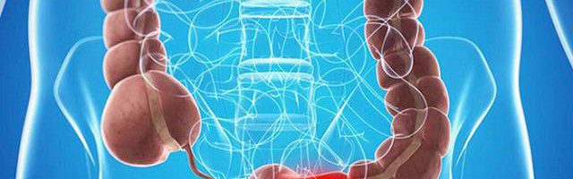 Ung thư ruột già khác bệnh trĩ như thế nào?