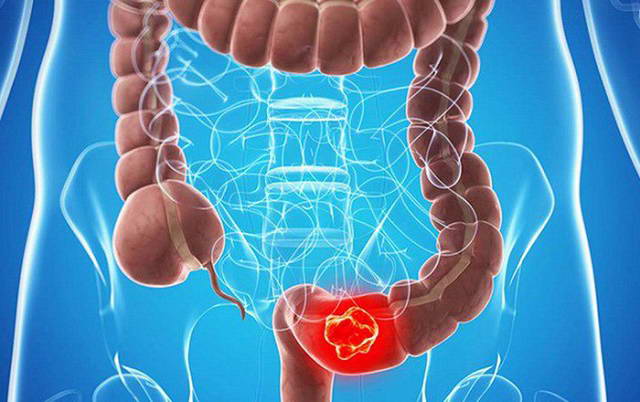Ung thư ruột già khác bệnh trĩ như thế nào?
