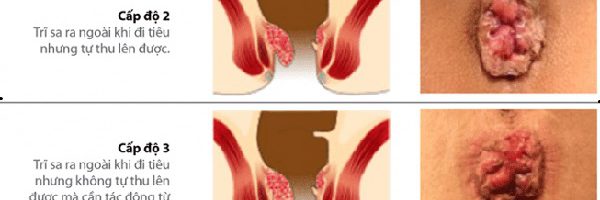 Thời gian phát triển bệnh trĩ là bao lâu