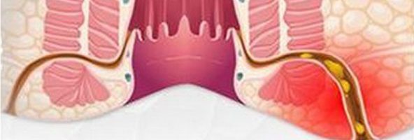 Rò hậu môn nhẹ có tự khỏi không?