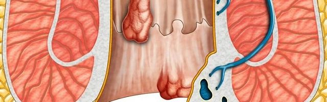 Mẹo vặt cho người bệnh trĩ hỗn hợp