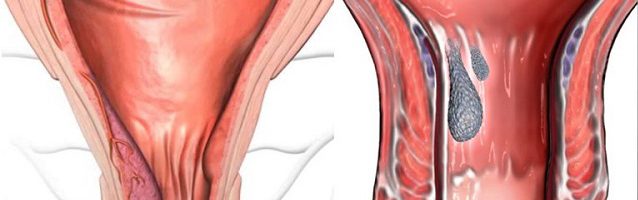 Phân biệt sa trực tràng và trĩ