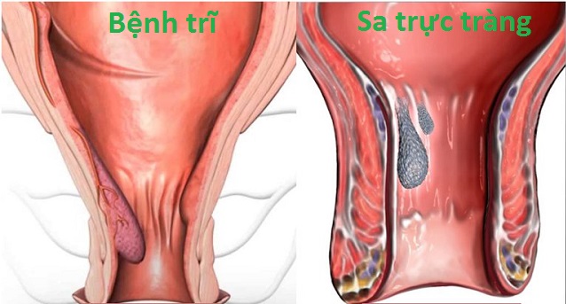 Phân biệt sa trực tràng và trĩ