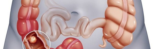 5 dấu hiệu cảnh báo bệnh polyp đại trực tràng