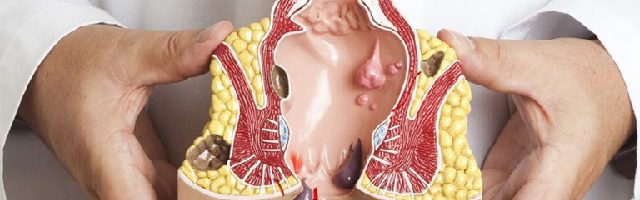 Điều trị bệnh trĩ ngoại và nội khác nhau như nào