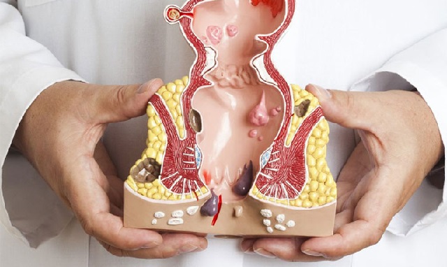 Điều trị bệnh trĩ ngoại và nội khác nhau như nào