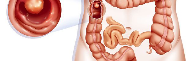 5 dấu hiệu cảnh báo bệnh polyp đại trực tràng