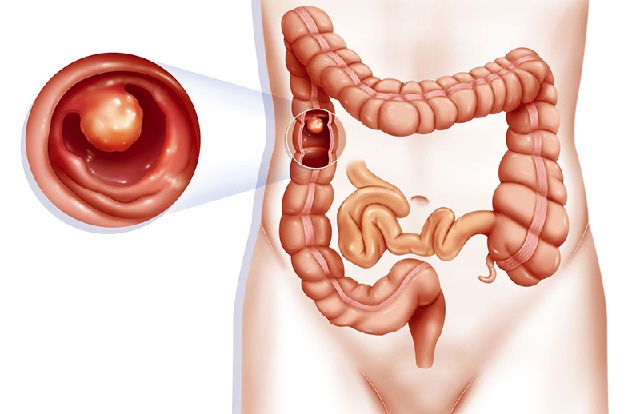 Khi nào cần sàng lọc polyp và ung thư đại trực tràng?
