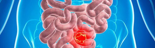 Triệu chứng đầu tiên khi ung thư ruột và các nhóm có nguy cơ cao