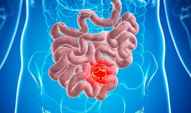 Triệu chứng đầu tiên khi ung thư ruột và các nhóm có nguy cơ cao