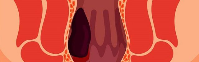 Biến chứng nguy hiểm của bệnh trĩ