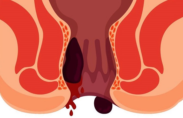 Biến chứng nguy hiểm của bệnh trĩ