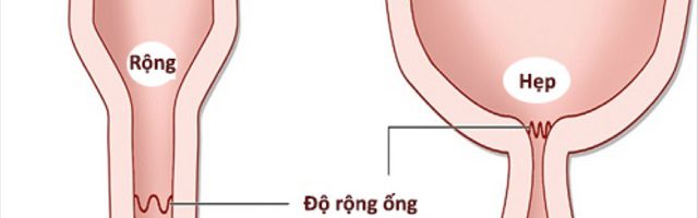 Bệnh trĩ có thể gây hẹp hậu môn