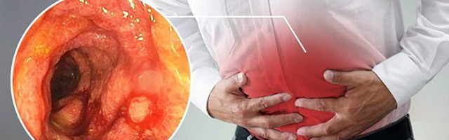 Bệnh trĩ làm tăng nguy cơ viêm loét đại trực tràng