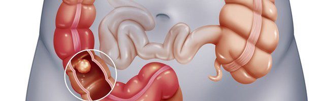Dấu hiệu nhận biết ung thư đại trực tràng