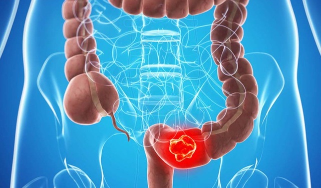 Bệnh trĩ khiến gia tăng nguy cơ ung thư đại trực tràng