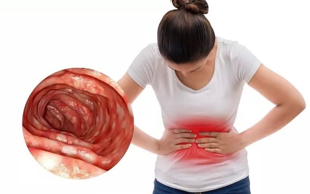 Triệu chứng bệnh viêm đại tràng