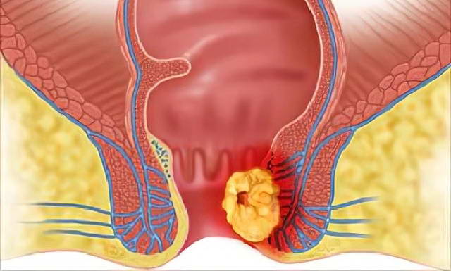 Nguyên tắc phòng ngừa ung thư hậu môn